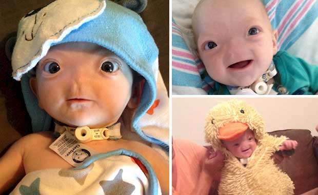 Baby Born Without A Nose Is The Internet’s Happiest, Most Adorable Baby