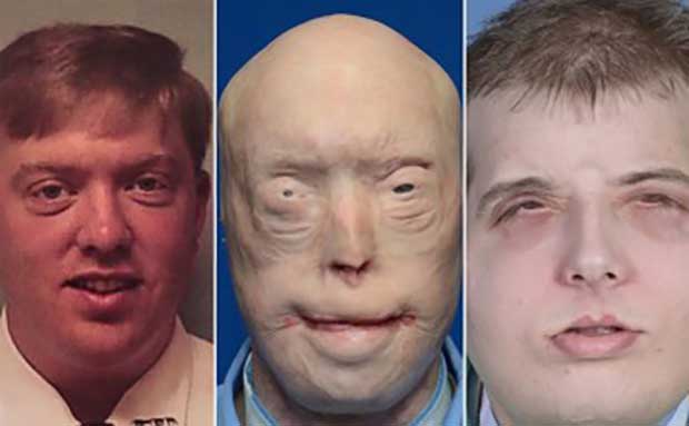 Firefighter Receives ‘Most Extensive’ Face Transplant Ever