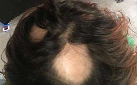 Suit Alleges Wen By Chaz Dean Products Lead To Hair Loss