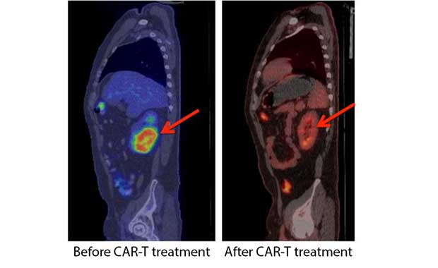 Memory Cells May Be Key to Fighting Blood Cancers