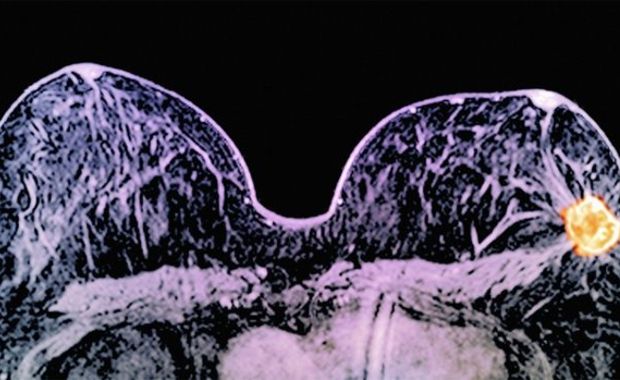 New Miracle Drug Can Shrink Breast Cancer Tumors in 11 Days