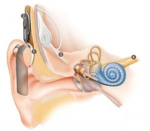 Courtesy Cochlear.com