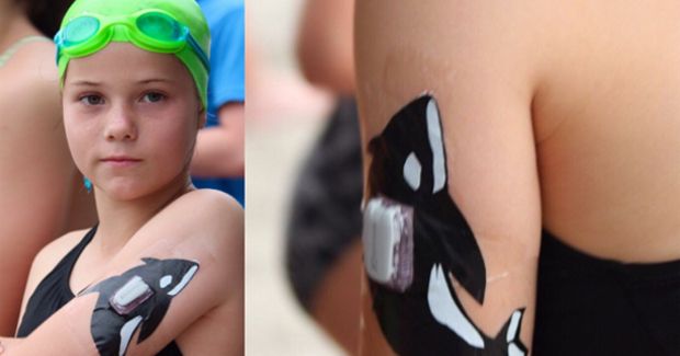 Creative Dad Comes Up With Artistic Design to Cover Up Daughter’s Diabetic Device
