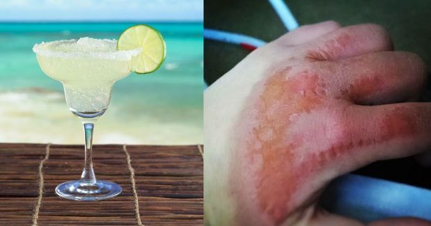 Beware: Lime Juice Can Lead to Severe Burns