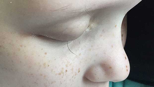 Touching Photo of a Girl’s Last Eyelash After Cancer Treatments Will Bring You to Tears