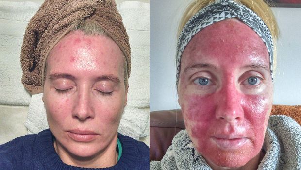 Woman Bravely Documents Her Skin Cancer Treatment to Raise Awareness