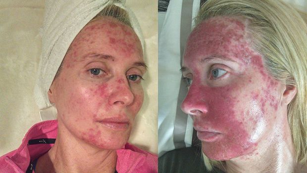 Margaret Murphy Documented Her Skin Cancer Treatment to Raise Awareness