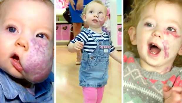 2-Year-Old's facial tumor