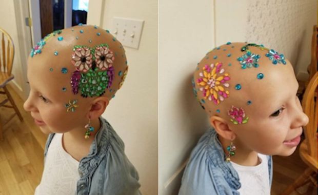 This 7-Year-Old With Alopecia Found a Clever Way to Celebrate Crazy Hair Day at School
