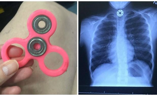 Calming Fidget Spinner Caused Choking Incident