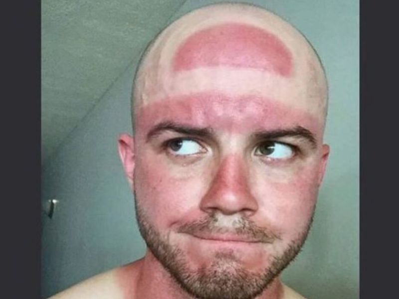 hat sunburn