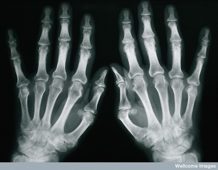 Psoriatic Arthritis: Why You Should Get Help Now