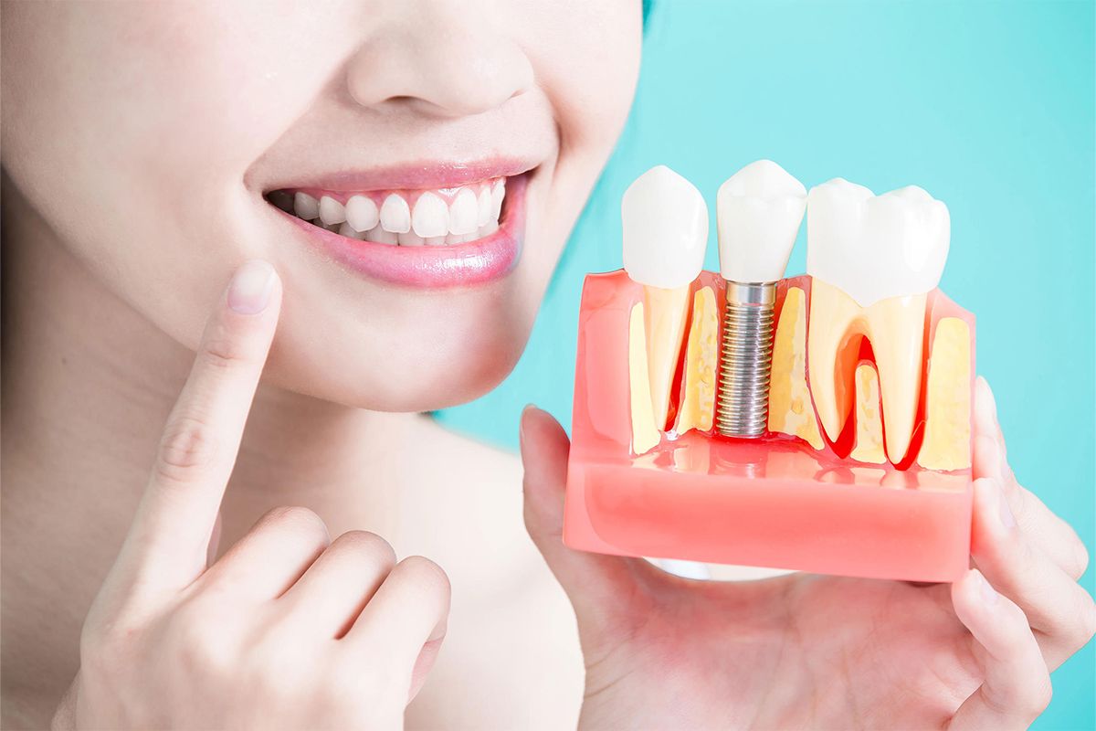Free Dental Implants for Seniors: A Step-By-Step Guide