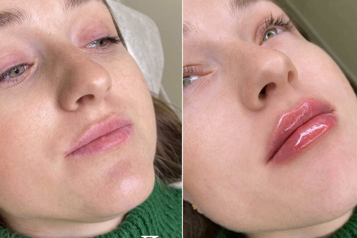 Unlocking the Power of Juvederm 11 Benefits for Achieving a Youthful