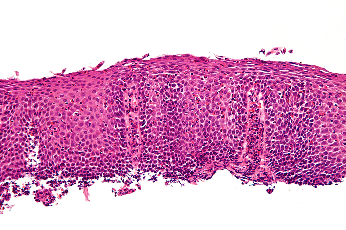 13 Signs You May Have Eosinophilic Esophagitis