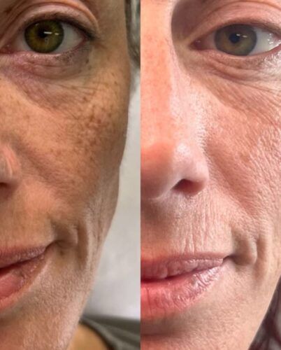 tixel treatment before and after