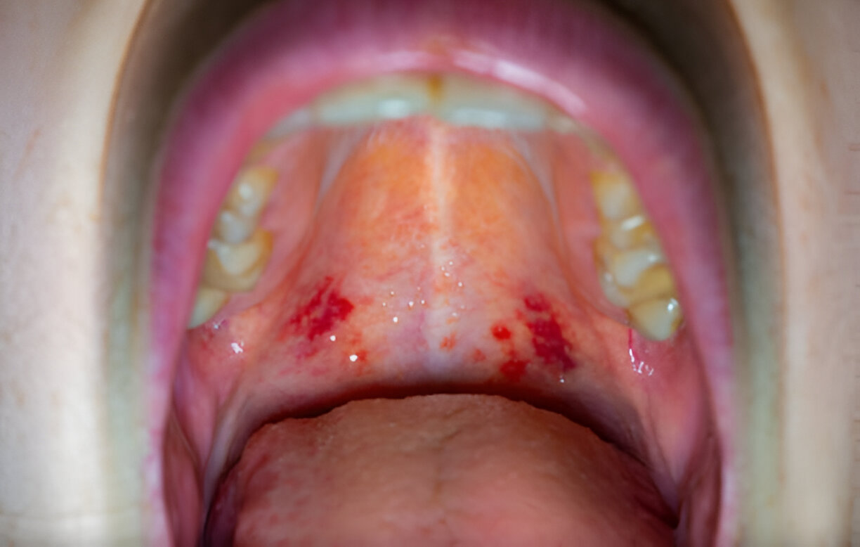Why Does the Top of My Mouth Hurt: Know Reasons and Tips