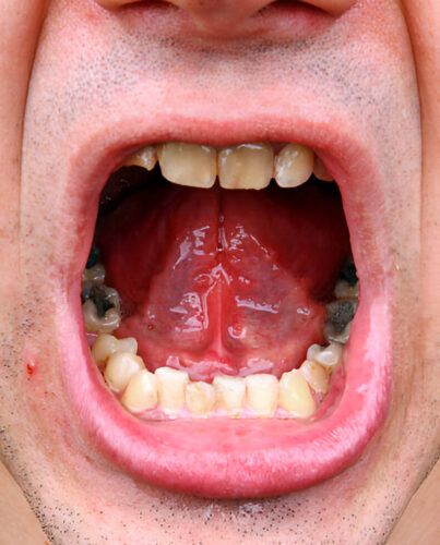 roof of mouth inflamed