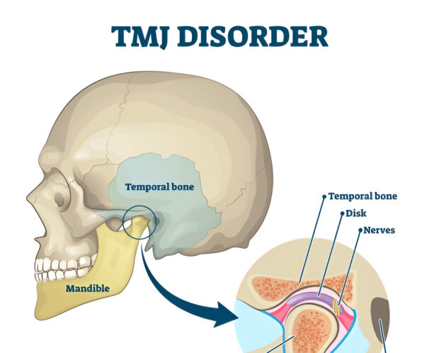 what is tmj disorder