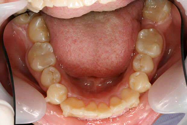 when do toddlers get molars